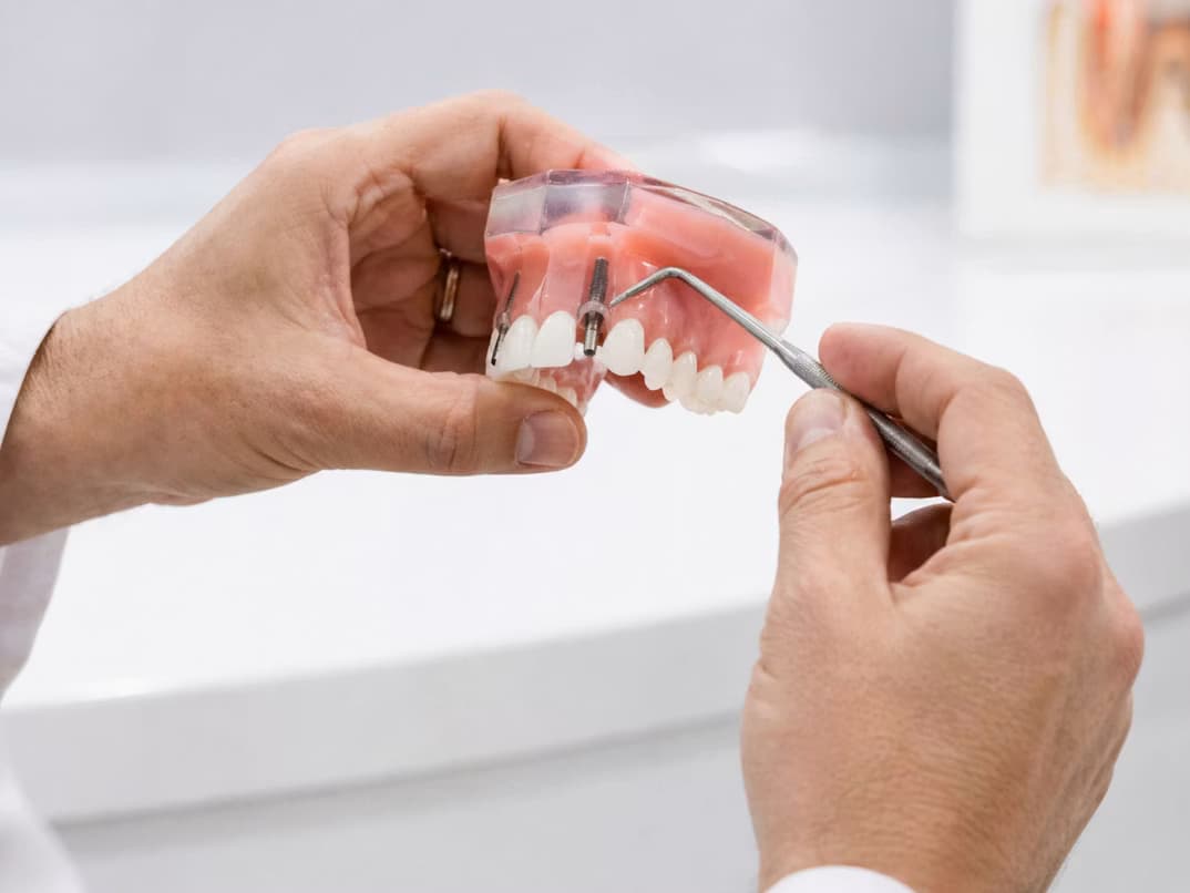 Implantes